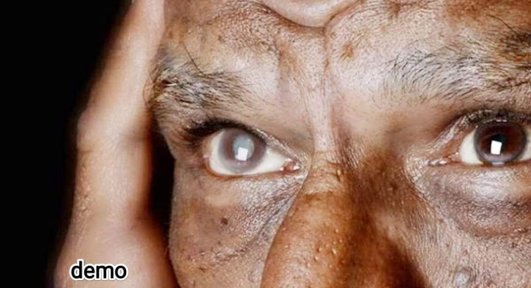 ब्रेकिंग न्यूज़ ऑपरेशन के बाद चली गई मरीज के आंख की रोशनी....... 2 056c5848 7c0c 493f 9fb2 741c42d646d9